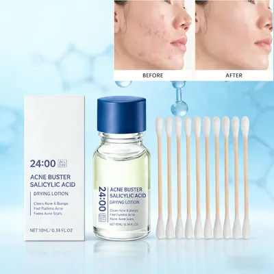Salicylic Acid Acne Buster Remover Blackhead Oil Control Tenderizing Delicate Pores Pimple Spot Remover Facial Skin Care Essence