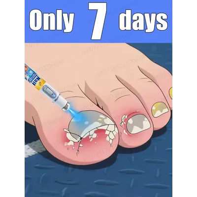 Technology changes life and says goodbye to onychomycosis