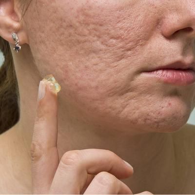 TCM Acne Scar Cream Natural Herbal Treatment For Clear, Smooth Skin TCM Acne Scar Cream Natural Herbal Treatment For Clear, Smooth Skin