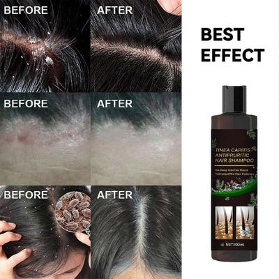 Kutinaa estävä shampoo Tinea Capitisille hilseeseen ja lievittää kutiavaa päänahkaa Monivärinen