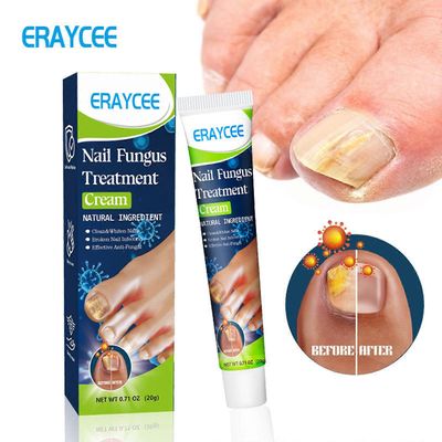 unbrand Sienikynsivoide, kynsien korjausvoide, vahva sieniä estävä varpaankynsivoide, kynsien korjaus ravitseva hoito, palauttaa värjäytyneet ja va...