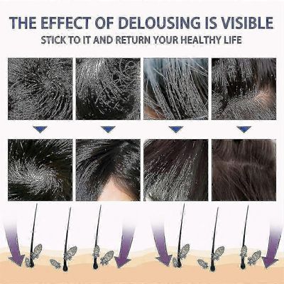 Päätäiden poisto Spray Karvat Poistaa täitä ja kirppuja Poistaa täiden munat ja P