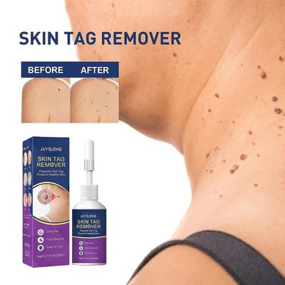 Riyan Jaysuing Gram Wart Agent Skin Spesielt Chicken Eye Meat Thorn Body Meat Neck Liquid Flat Plantar Wart Clear Wart Liquid