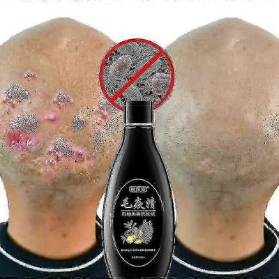 Päänahan karvatupi shampoo Antibakteerinen kutinaa estävä punkkien öljyn hallinta