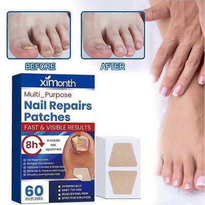 60kpl(A)$Ximonth Kynsien korjauslaastarit käsille ja jaloille Pehmeät kynnet Sisäänkasvaneet kynnet paksuuntuvat kirkkaat kynnet Kynsiuran Onykomyk...