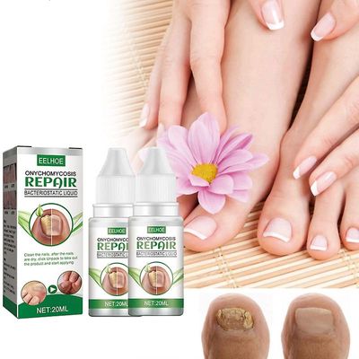 3X essensiell olje spiker sopp reparasjon flytende neglefortykkelse misfarging av myk neglefortykning type onychomyc 20ml