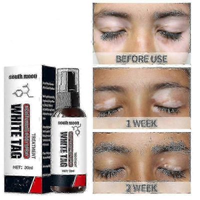 2025 Vitiligo-suihke, Vitiligohoito iholle Vitiligo, Vitiligo Care Spray valkoisten täplien vähentämiseen