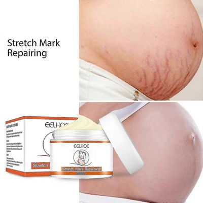 2x Venytysmerkkien poisto Voide Rasvan kasvuraidat Äitiysarvet Aknen korjaus Lisää ihon kimmoisuutta Ryppyjä estävä kiinteä vartalonhoito