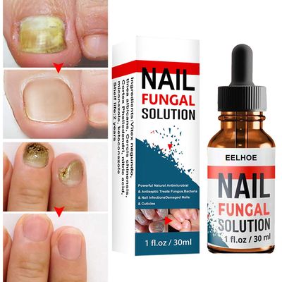 Nail Reparasjon Solution Hand &Foot Grey Nail Care Reparasjon Grey Nail Solution Fortykning Soft Nail 30ml Box