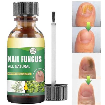 30 ml: n varpaankynsien sienten hoito, teepuuöljy varpaankynsien sienelle, sienilääke kynsiliuoksen hoito olemus
