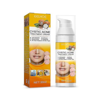 Acne Treat Cream för cystisk, hormonell, och svår akne