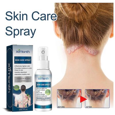 Psoriasis Treatment Spray Scalp Recovery Therapy, Scalp Psoriasis Treatment Spray, Skin Recovery Psoriasis Control Moisturizing Spray 1pcs