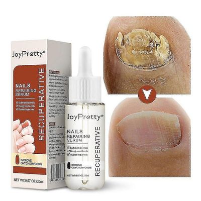 Sieni kynsien hoitoseerumi Paksu kynsi pehmeä kynsien korjaus Essence Voide Varpaiden valkaisu hoito Hoito