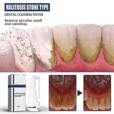 Hammaskivi- Liukeneva hammaskiven poisto Hampaiden täydellinen poisto Tootaste