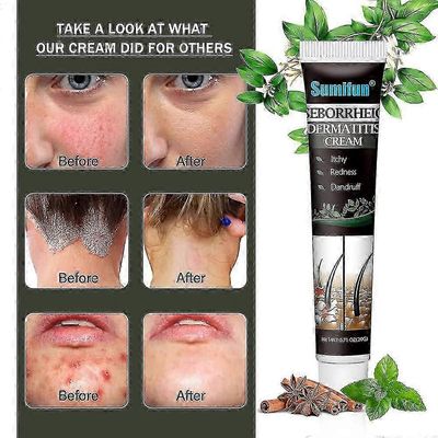 Guangzhou Aidai Trading Co., Ltd Psoriaattisen seborrooisen dermatiitin hoito kerma pää akne kutina päänahka silsa korjata iho puhdistusvoide hiuks...