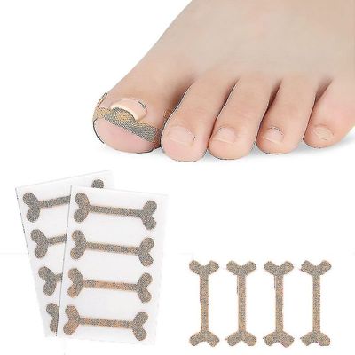 Mikasa 4 Pack tå søm groove fod søm ortodontisk enhed tommelfinger negleplaster hurtig pedicure tå søm