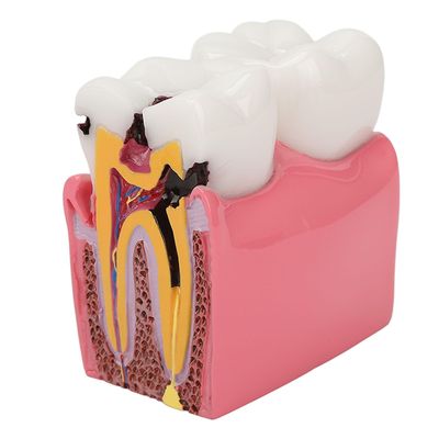 2024 Ny,Dental Caries Model Tooth 6X Decay Demonstration Model til undervisning i studielaboratorier