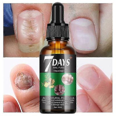 7 päivän kynsisienihoito, 7 päivän kynsien kasvu ja seerumin kynsien vahvistaminen, kynsien korjausliuos, terveiden kynsien palauttaminen 1 kpl