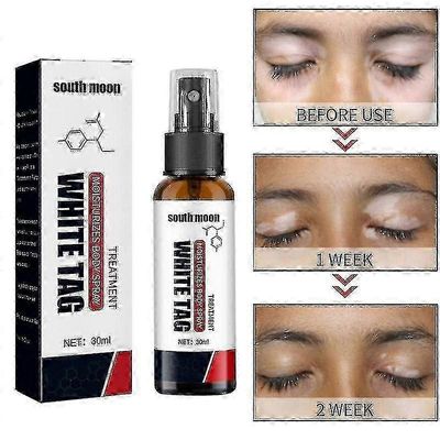 Vitiligo-hoito Spr