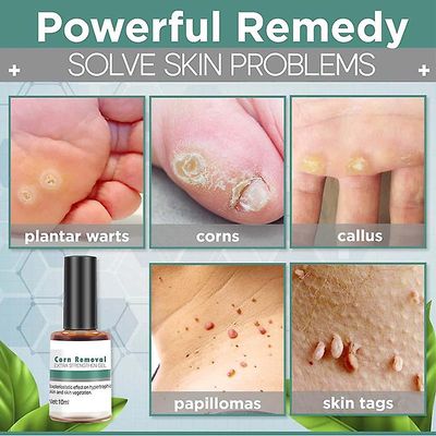 Corn Removal Extra Styrke Gel, Quick Corn Callus Remover Liquid, Foot vorter Removal Plantarvorter Salve Mild Corn Callus Vorter Remover til fødder...