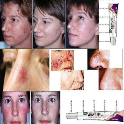 Facial Varicose Vein Cream Anti Redness Spider Vein Remover Avansert behandling C