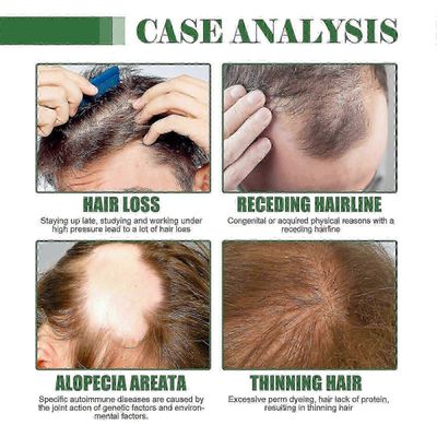 100 % puhdasta batanaöljyä hiusten kasvuun Luonnollinen päänahan hoito Ravitseva öljy paksummille, vahvemmille hiuksille ja vähentää hiustenlähtöä ...