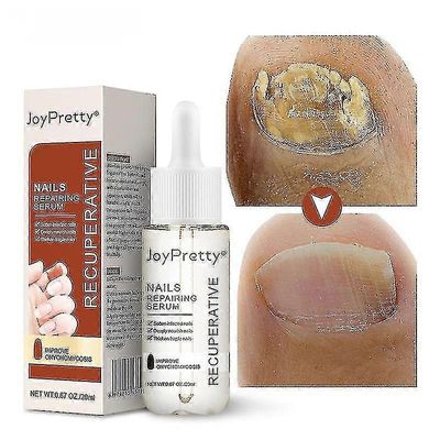 1/2/3kpl onychomycosis nestemäinen kovera ja kupera karkea kynsipiste onychomycosis pehmeä kynsien korjaus nestemäinen sormen reunaöljy kynsien kor...