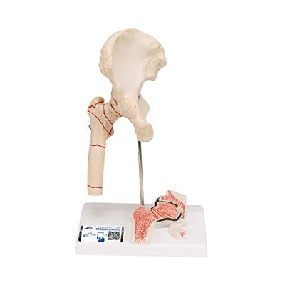 3B Scientific Menselijke anatomie - dijbeenbreuk en heupslijtage + gratis anatomie app - 3B Smart Anatomy