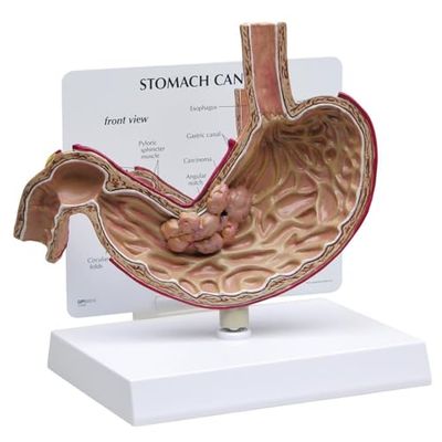 GPI Anatomicals Model raka żołądka