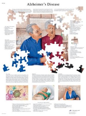 3B Scientific Anatomie humaine - Tableau des maladies d'Alzheimer, version plastifiée