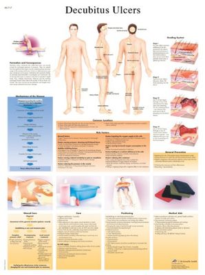 3B Scientific Vetenskaplig decubitus Ulcers diagram, laminated, 1