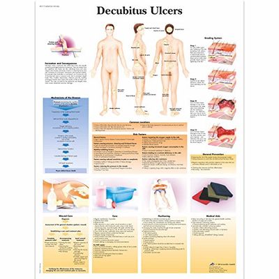 3B Scientific Vetenskaplig decubitus Ulcers diagram, unlaminated