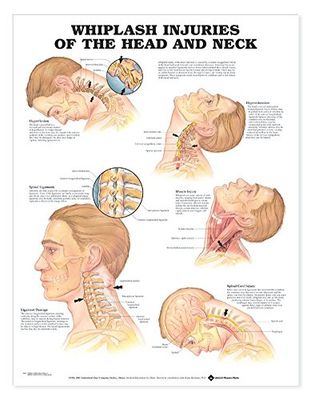 Whiplash Injuries of the Head and Neck Anatomical Chart