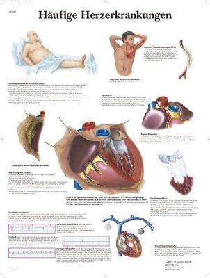 3B Scientific VR0343UU - Póster explicativo sobre enfermedades comunes del corazón (en alemán)