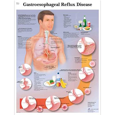 3B Scientific Anatomie humaine - Tableau des maladies du reflux gastro-œsophagien, version plastifiée