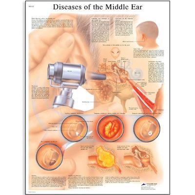 3B Scientific Vetenskaplig mänsklig anatomi – sjukdomar i mellanörat diagrammet, pappersversion