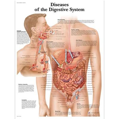 3B Scientific Vetenskaplig mänsklig anatomi - Sjukdomar i matsmältningssystemet, laminerad version