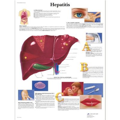 3B Scientific Anatomia człowieka - tabela zapalenia wątroby, wersja laminowana