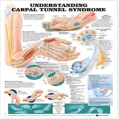 Understanding Carpal Tunnel Syndrome Anatomical Chart