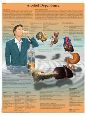 3B Scientific Vetenskaplig mänsklig anatomi - Alkoholberoende diagram, laminerad version