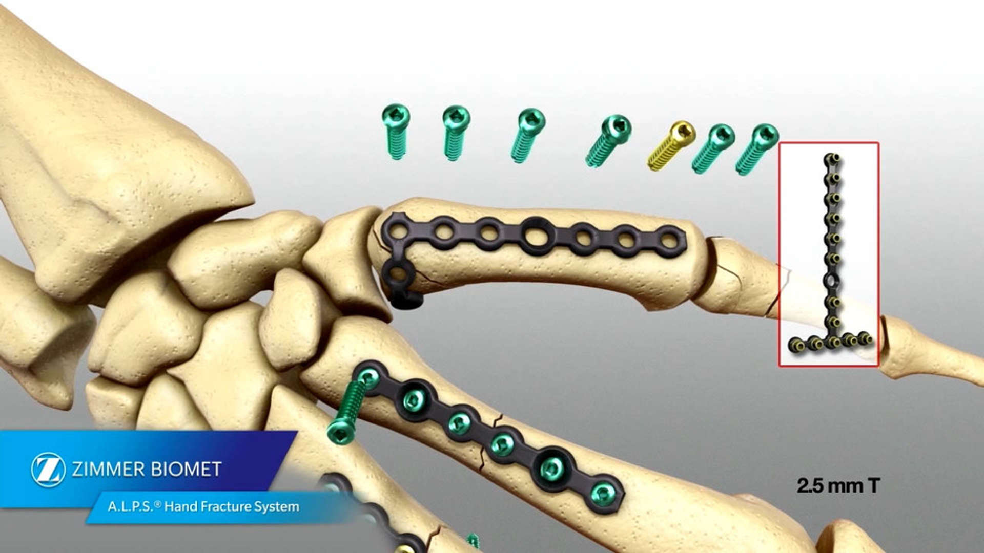 Hand Fracture System