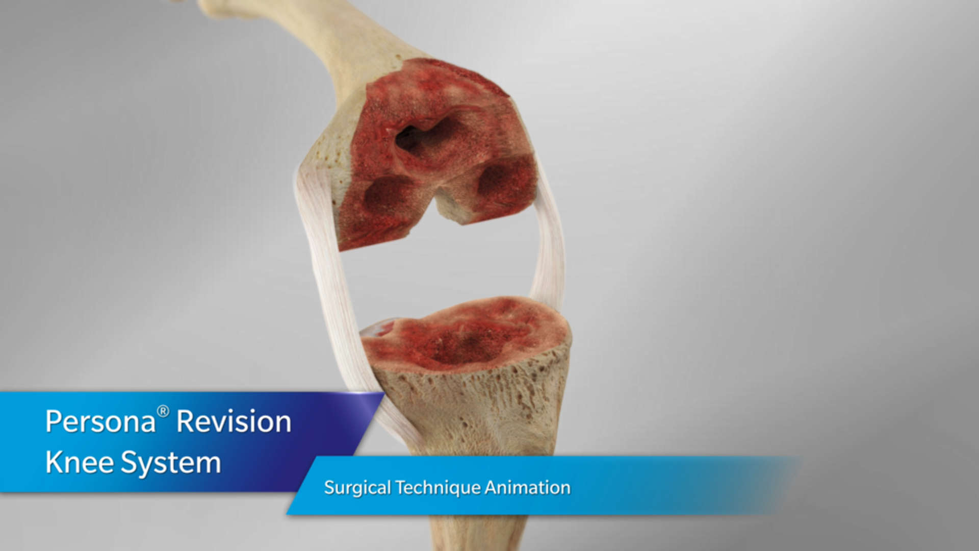 Persona® Revision Knee Surgical Technique Animation