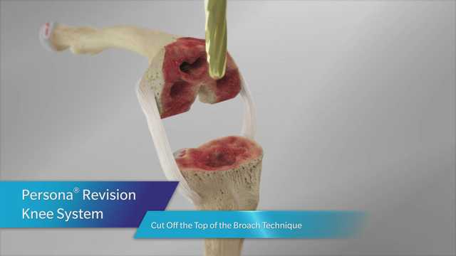 Persona® Revision Cut Off Top of Broach Animation
