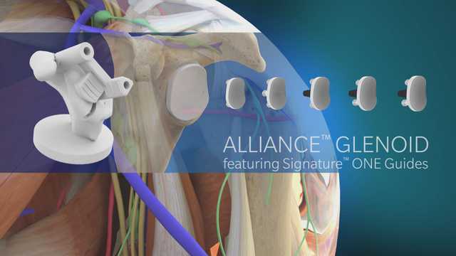 Alliance Glenoid in Signature ONE Pre-Planning