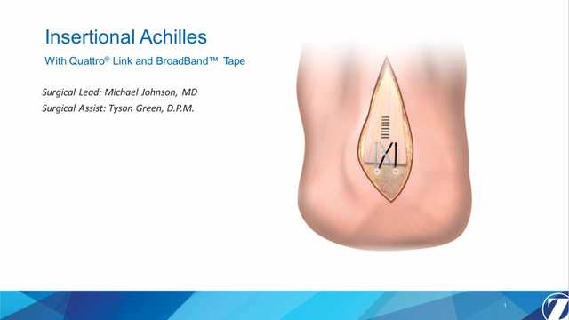 Insertional Achilles With Quattro® Link and BroadBand® Tape 