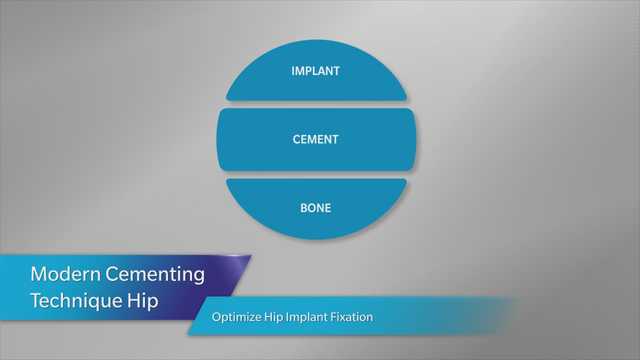 Modern Cementing Technique (MCT) for Hip feat. CPT® 12/14 Hip System