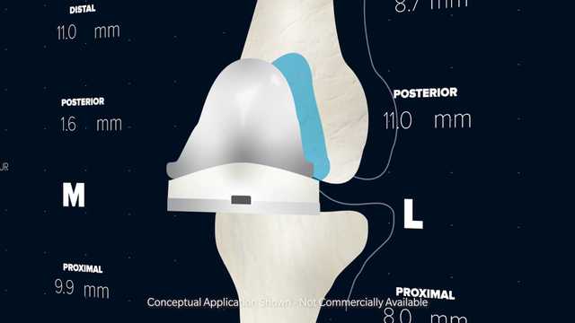 Dr. Atul Kamath ROSA Knee Surgeon Insights 2023