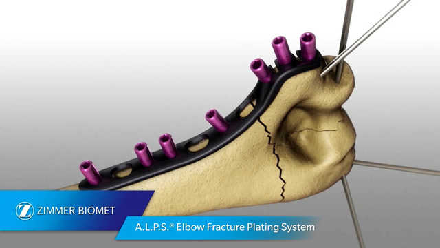 A.L.P.S.®  Elbow Fracture Plating System