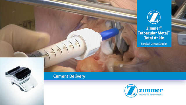 Cement Delivery for the Zimmer® Trabecular Metal™ Total Ankle