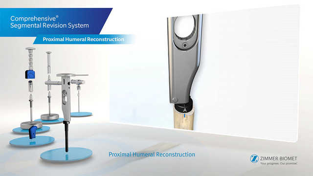 Comprehensive® Segmental Revision System - Proximal Humeral Resection